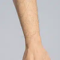 前臂毛