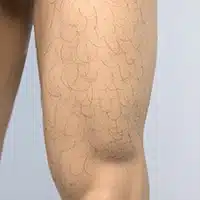 大腿毛